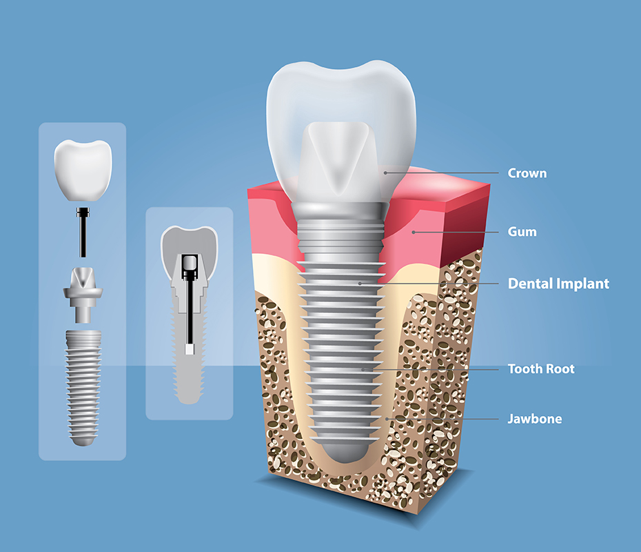 インプラント治療の特徴イメージ